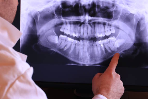 Best Emergency Dentist for Lost Fillings or Crowns in Morton, PA